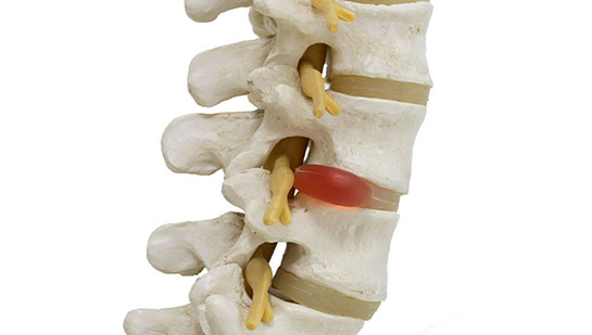 Herniated disc in spine before visiting Cary chiropractor