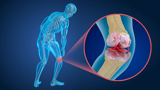 Osteoporosis pain in the knee before chiropractic treatment from Cary chiropractor