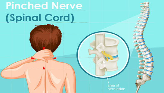 Pinched nerve in spine before chiropractic treatment from Cary chiropractor