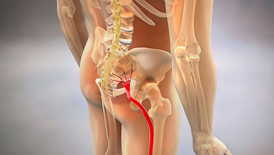 Sciatic nerve pain before chiropractic treatment from Cary chiropractor